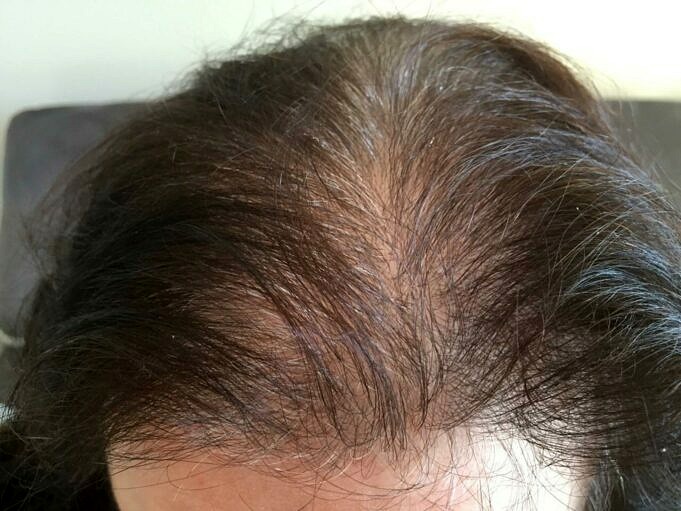 Chute De Cheveux Temporaire. Les Causes Les Symptomes Et Les Traitements
