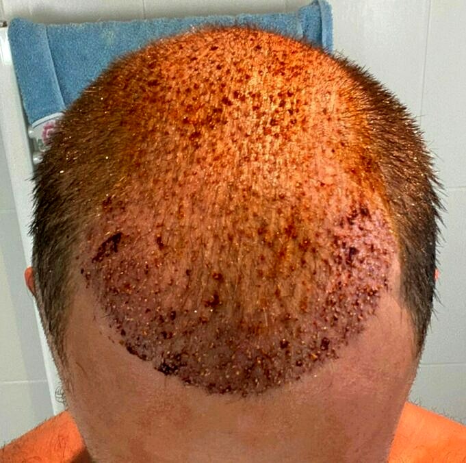 Cicatrices De Greffe De Cheveux. Guide Ultime 2022
